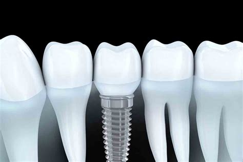 costa rica dental implants problems